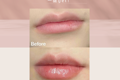 Lip Filler?唇部美學(xué)，一鍵get！