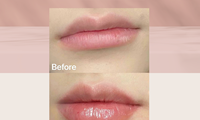 Lip Filler?唇部美學，一鍵get！