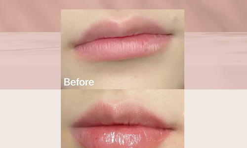 Lip Filler?唇部美學，一鍵get！