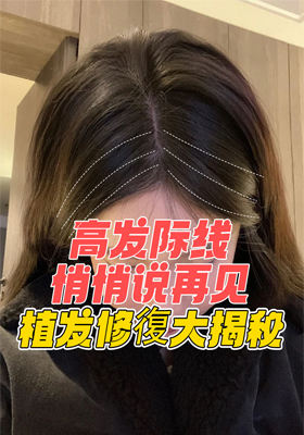 高發際線悄悄說再見！植發修復大揭秘
