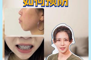什么是牙套臉，如何預防？